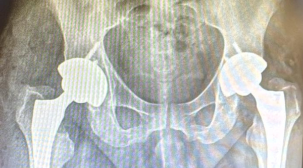 Hospital Ouro Branco realiza duas artroplastias totais de quadril inéditas no mesmo ato operatório